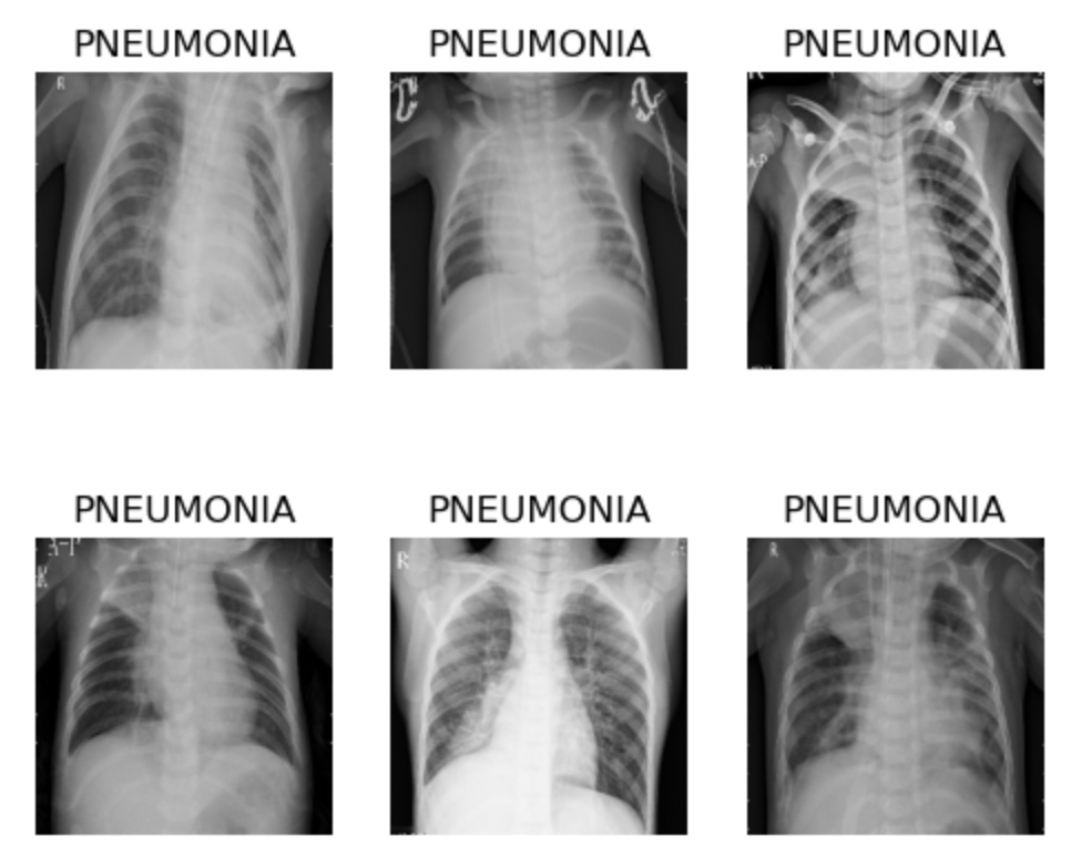 Pneumonia